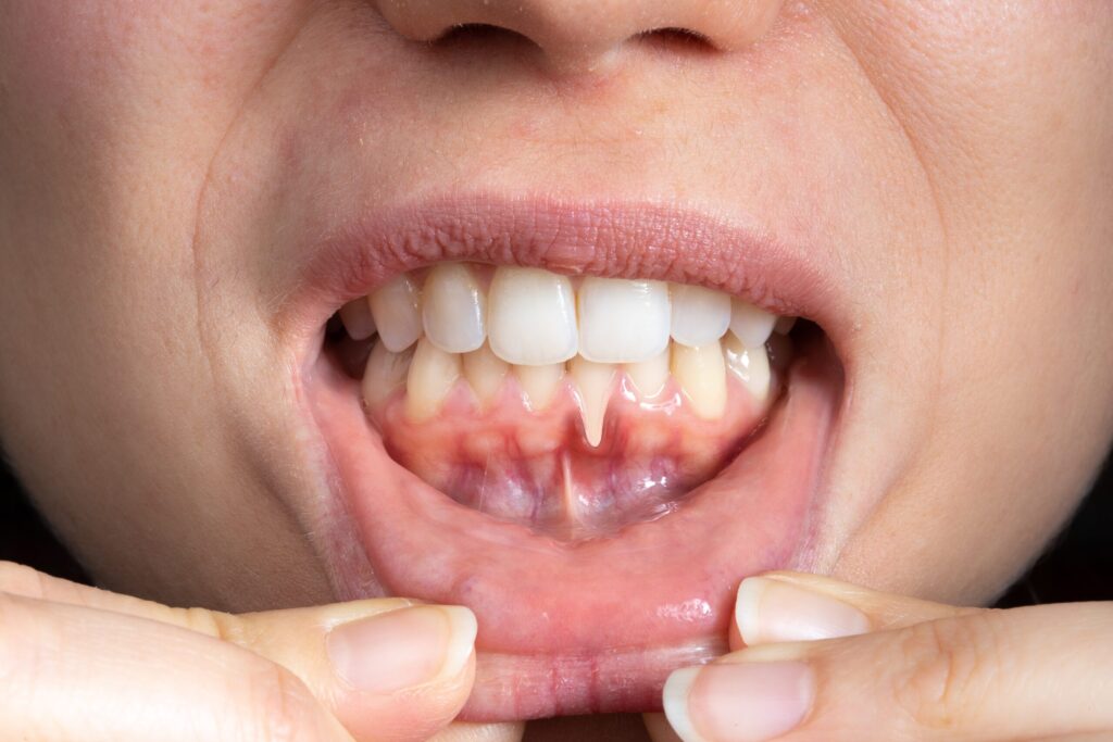 Preparing for teeth whitening with receding gums Aylesbury